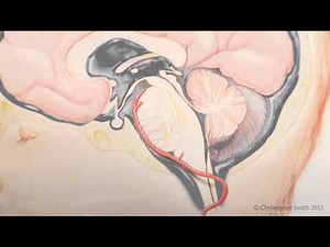 Intra-arterial Chemotherapy for the Treatment of Progressive Diffuse Intrinsic Pontine Gliomas