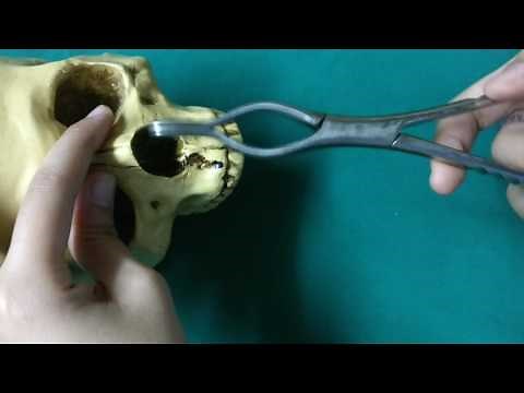 Asch forceps walsham forceps