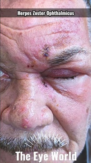 Herpes Zoster Ophthalmicus