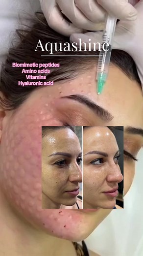 Revitalize Your Skin with Aquashine Skin Booster Treatment