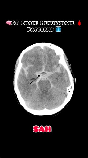 Dr.Akshara on Instagram: "👀 Can you spot the difference between SAH, EDH, and SDH? This CT scan tells a life-saving story 1.SAH – Subarachnoid Hemorrhage 📍 Blood in sulci & basal cisterns ⚡ Thunderclap headache 🩺 Common cause: Aneurysm 2.SDH – Subdural Hematoma 📍 Crescent-shaped bleed 🧓 Elderly / Alcohol use / Trauma 🩺 Bridging veins 3.EDH – Epidural Hematoma 📍 Biconvex / Lens-shaped bleed 💥 Head injury ⏳ “Lucid interval” may occur 🩺 Middle meningeal artery 4.IPH – Intraparenchymal Hemo