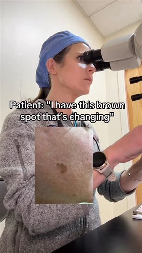 Dr. Abigail Waldman, MD FAAD on Instagram: "Early melanomas often present as brown, tan or even pink patches that are changing. This could be a change in size, color, shape or symmetry. If a brown spot is new in the last 8 weeks or changing then worth pointing out to your doctor. Early melanoma has an excellent prognosis when caught and treated early. On pathology MART1 stain highlights the abnormal cells dark brown with blue being the normal background. Features of early melanoma on pathology s