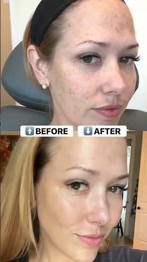 BBL + MOXI Laser healing journey: laser results #bbllaser #moxilaser