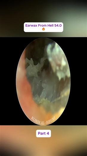 Part 4 Earwax From Hell 54.0🔥 #earwax #earwaxremoval #earcleaning #eardoctor #restorationvideos