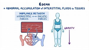 Video: Approach to lower limb edema: Clinical sciences - Video Explanation! | Osmosis | Osmosis
