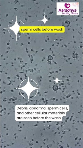 Pre-Wash vs Post-Wash Sperm Sample | Understanding How Sperm Motility Impacts Pregnancy