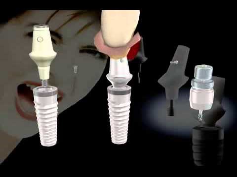 Ankylos Implant System