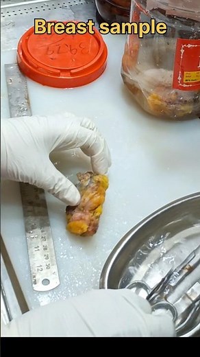 Breast lump sample processing 😞| #histopathology #breastgrowth #breastcancer #breastcancerawareness