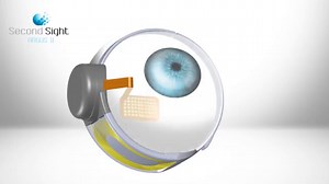 ‘Bionic Eye’ Helps the Blind to Partially See