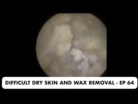 DIFFICULT DRY SKIN AND EAR WAX REMOVAL - EP 64