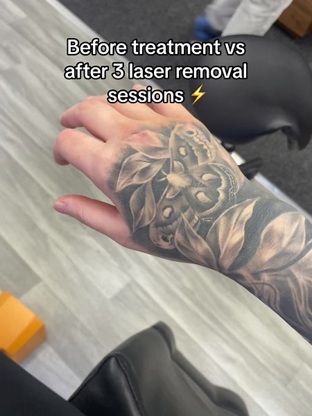 Tattoo Removal Before and After Transformations