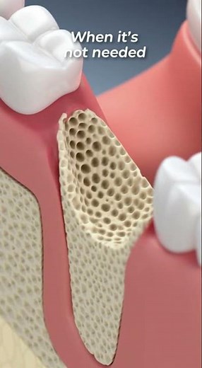 🦷 No Bone Graft After a Tooth Extraction? That Can Be Normal