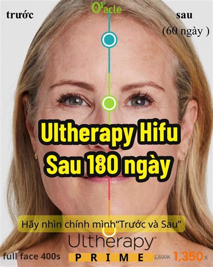 Ultherapy Prime: Xu Hướng HIFU Nâng Cơ 2026