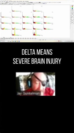 What Delta Waves Reveal About Severe Brain Injury | NeuroNoodle Shorts