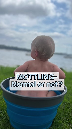 Understanding Mottled Skin in Babies and Children