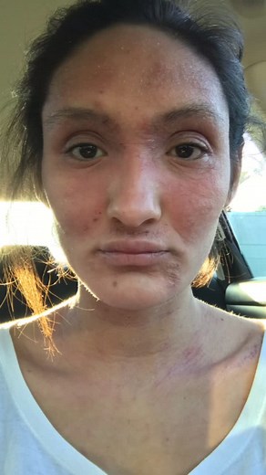 Understanding Eczema and Healing Over Time