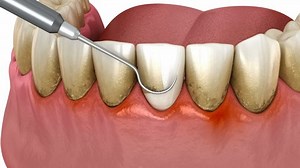 Dental Scaling Conventional Periodontal Therapy Medically Stock Footage Video (100% Royalty-free) 1096602315 | Shutterstock