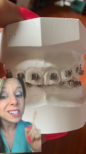 Identifying an Overbite: Signs, Symptoms, and Solutions