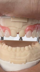 Replacing all but two Upper Teeth! Case from Dr. Marvin McQueen in Mississippi! @_etec_ @corinthdental | CEO Luke Kahng