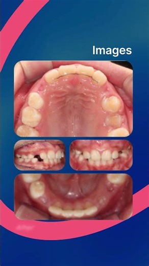 Successful overjet treatment with Invisalign at Dulwich, London