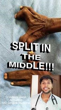 Not your regular hand!!🤚🏽Ectrodactyly & Syndactyly in 60 seconds !!