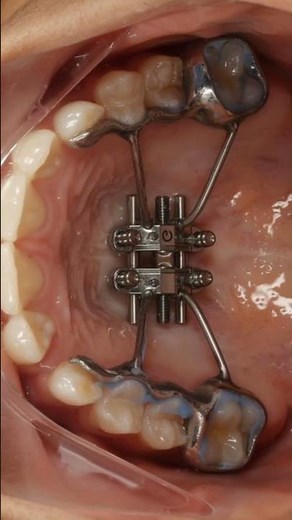 MSE Midfacial expansion #airwayorthodontics #drkovalorthodontics #airway