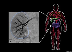 Polyarteritis nodosa
