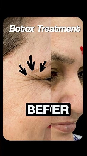✨ Botox Before & After Results | Smooth, Youthful Skin Transformation | Skinaa Clinic #dermatology