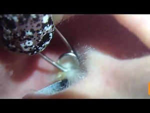 Ear cyst explosion popping