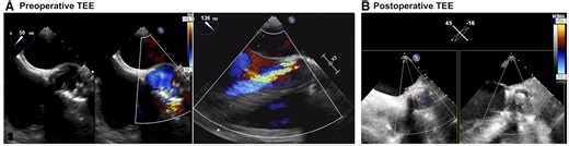 Successful redo aortic valve replacement using Perceval for multiple recurrent prosthetic valve dysfunction
