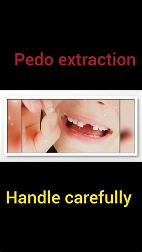 Tooth Extraction!!#trending #shorts #short #short #shortsfeed #shortsvideo #shortsviral