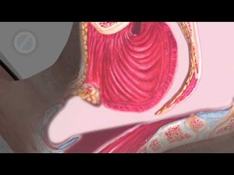 Obstructive Sleep Apnea Animation