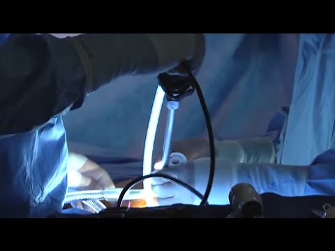 Minimally Invasive Pancreatic Surgery | Patient Story