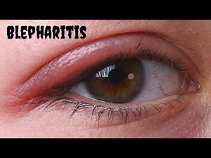 blepharitis treatment at home | 5 Home Remedies For Blepharitis - clickbank review