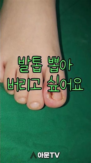 Nail Pain, What’s the Treatment? (Ingrown Toenail Electrocautery Correction Pain Surgery Inflamma...