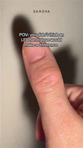 POV: I Blinked… and My Skin Started Healing ✨ #dermatillomania #skinhealing #skincare