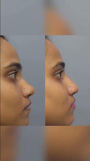 "The Future of Nose Reshaping: 5 Facts About Non-Surgical Rhinoplasty!"