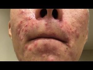 HOW TO GET RID OF PIMPLES IN 1 DAY INSANE RESULTS