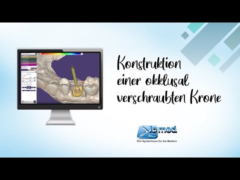 Konstruktion und Design einer okklusal verschraubten Krone in exocad