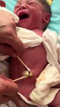 👶 Umbilical Cord Dressing | बच्चे की नाभि की देखभाल कैसे करें? #shorts #youtubeshorts #viral #baby