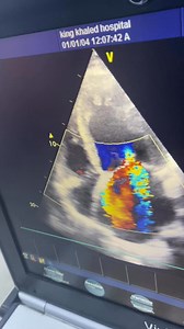 7.7K views · 47 reactions | Mitral insufficiency #CCU_ECHO | CCU | Facebook