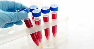 PDW - normy, obniżone i podwyższone PDW. Czym jest anizocytoza? [WYJAŚNIAMY]