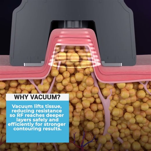 Vacuum-Enhanced RF: The Secret Behind Deeper Results