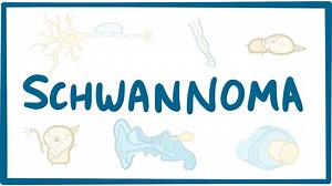 Acoustic neuroma (schwannoma): Video, Causes, & Meaning | Osmosis