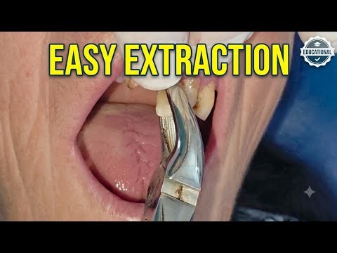 Atraumatic Upper Tooth Extraction: Forceps Technique & Extraction | Dental Procedure