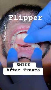 FLIPPER Acrylic Temporary Solution for Missing Teeth