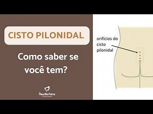 Cisto pilonidal: como saber se você tem?