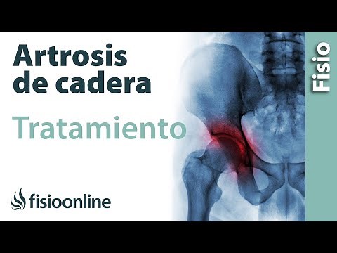Artrosis de cadera - Tratamiento con ejercicios, estiramientos y masajes