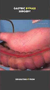 Gastric Bypass Surgery Explained | Step-by-Step Procedure & Recovery #gastricbypass