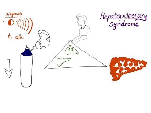 Hepatopulmonary syndrome, the clinical triad!